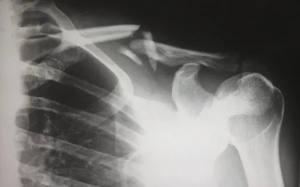 Personal Injury Lawsuit Process in Georgia