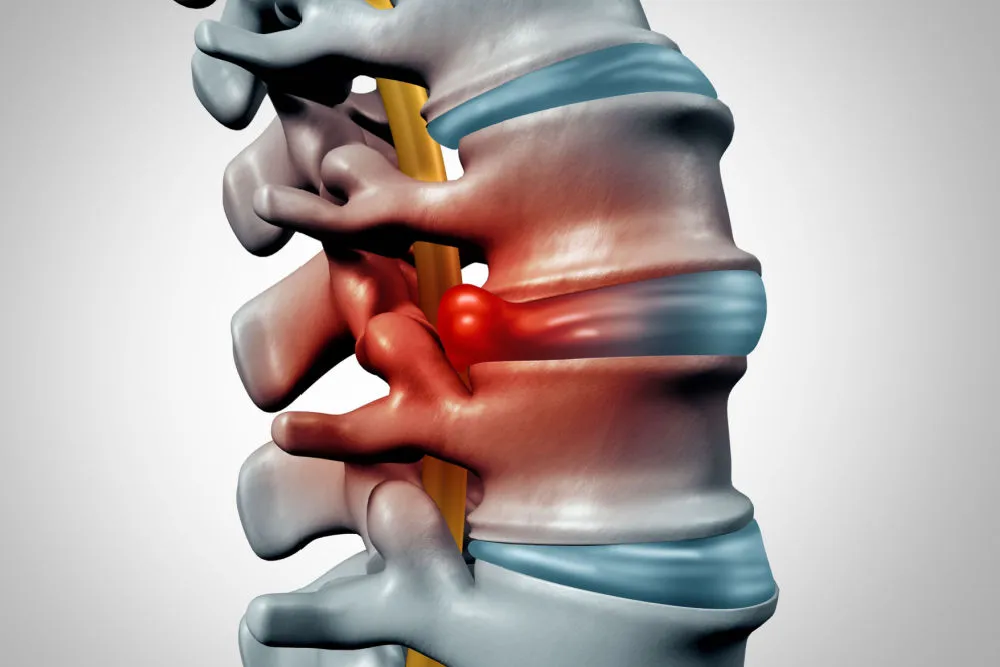 Bulging Disc from Car Accident Settlement