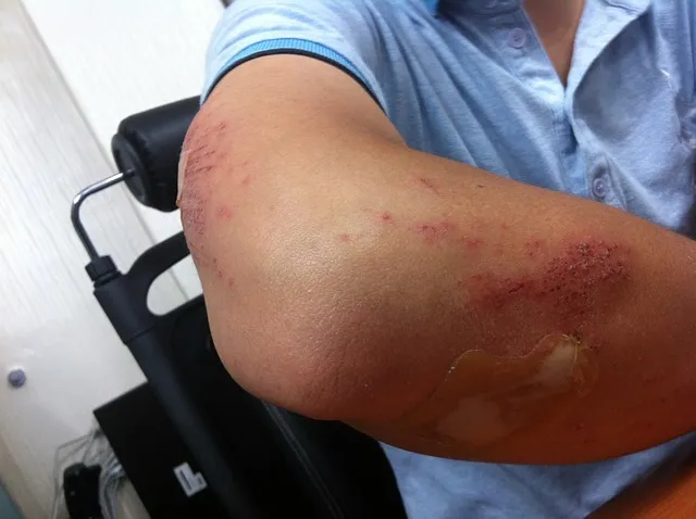 soft tissue shoulder injury